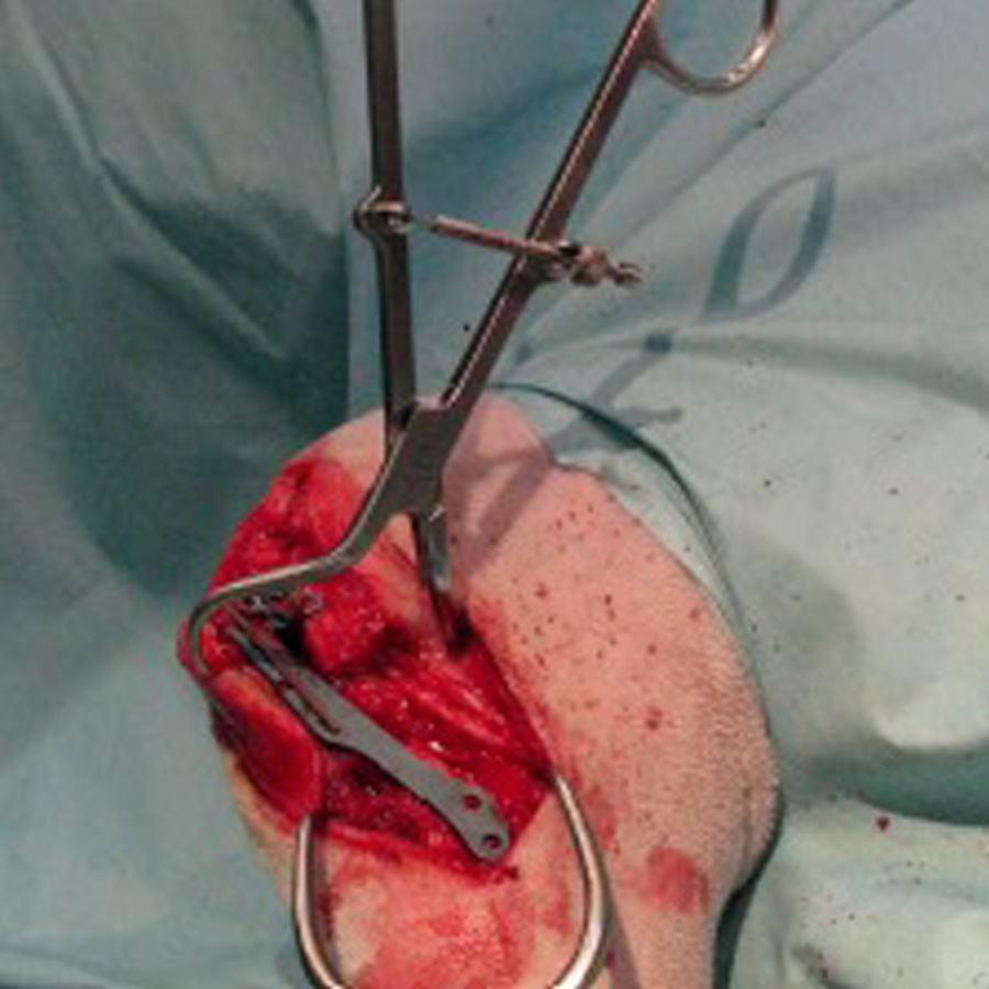 Mini Plate Holding Forceps Stainless Steel German - Image 3